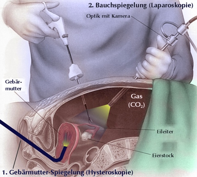 Gebärmutter- und Bauchspiegelung